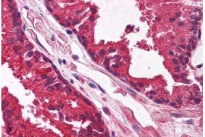 Human Prostate (formalin-fixed, paraffin-embedded) stained with KLF6 antibody ABIN214122 at 5 ug/ml followed by biotinylated goat anti-rabbit IgG secondary antibody ABIN481713, alkaline phosphatase-streptavidin and chromogen.
