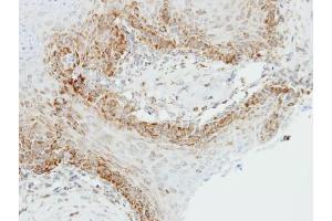 IHC-P Image Immunohistochemical analysis of paraffin-embedded Cal27 xenograft, using OGDH, antibody at 1:500 dilution.