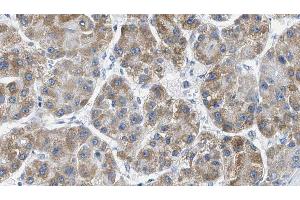 ABIN6269344 at 1/100 staining Human liver cancer tissue by IHC-P. (PAK1 anticorps  (Internal Region))