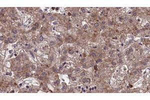 ABIN6273969 at 1/100 staining Human liver cancer tissue by IHC-P. (OR1J1 anticorps)