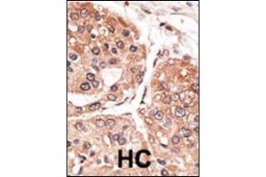 Formalin-fixed and paraffin-embedded human cancer tissue reacted with the primary antibody, which was peroxidase-conjugated to the secondary antibody, followed by DAB staining.