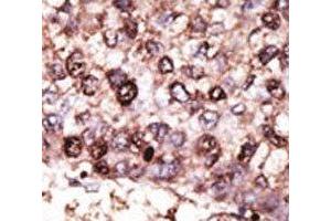 IHC analysis of FFPE human hepatocarcinoma tissue stained with the SIRT7 antibody (SIRT7 anticorps  (AA 331-360))