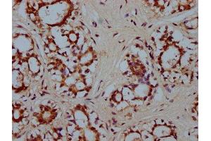 IHC image of ABIN7155703 diluted at 1:300 and staining in paraffin-embedded human breast cancer performed on a Leica BondTM system.