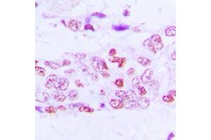 Immunohistochemical analysis of GSK3 alpha/beta (pY279/216) staining in human lung cancer formalin fixed paraffin embedded tissue section.