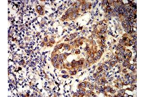 Immunohistochemical analysis of paraffin-embedded endometrial cancer tissues using ACVR1 mouse mAb with DAB staining.