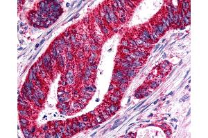 Anti-BOB / GPR15 antibody IHC of human Colon, Carcinoma. (GPR15 anticorps  (Cytoplasmic Domain))