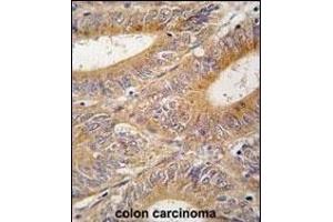 Formalin-fixed and paraffin-embedded human colon carcinoma tissue reacted with AIK antibody (N-term) (ABIN392389 and ABIN2842017) , which was peroxidase-conjugated to the secondary antibody, followed by DAB staining. (Aurora A anticorps  (N-Term))