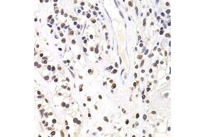 Immunohistochemistry of paraffin-embedded human kidney cancer using SOX5 antibody.