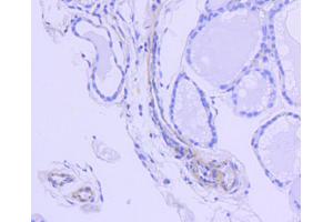 Immunohistochemistry of paraffin-embedded human thyroid using ROCK1 antibody (ABIN5997107) at dilution of 1/100 (40x lens). (ROCK1 anticorps)