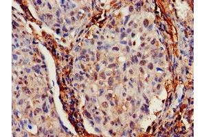 IHC image of ABIN7156683 diluted at 1:700 and staining in paraffin-embedded human lung cancer performed on a Leica BondTM system. (IFITM2 anticorps  (AA 1-56))
