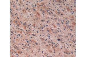 Used in DAB staining on fromalin fixed paraffin- embedded glioma tissue