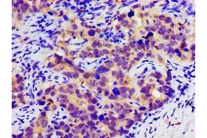 Immunohistochemistry of paraffin-embedded human pancreatic cancer using ABIN7146350 at dilution of 1:100 (SLC25A12 anticorps  (AA 202-317))