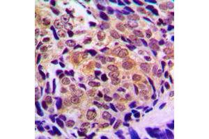 Immunohistochemical analysis of Histone Deacetylase 5/9 staining in human prostate cancer formalin fixed paraffin embedded tissue section. (HDAC5/9 anticorps  (Center))