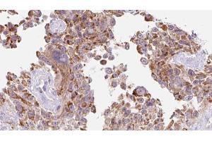 ABIN6273218 at 1/100 staining Human Melanoma tissue by IHC-P. (CTHRC1 anticorps  (Internal Region))
