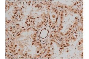ABIN6267333 at 1/200 staining Human lung cancer tissue sections by IHC-P.