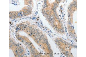 Immunohistochemistry of Human lung cancer using PIBF1 Polyclonal Antibody at dilution of 1:60 (PIBF1 anticorps)