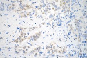 Immunohistochemistry was performed on paraffin-embedded human breast carcinoma using STAT5B antibody (ABIN7800348), 1:200). (Recombinant STAT5B anticorps)