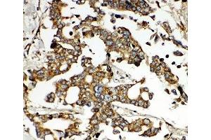 IHC-P: HNF6 antibody testing of human liver cancer tissue