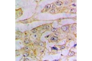 Immunohistochemical analysis of Ferritin L staining in human lung cancer formalin fixed paraffin embedded tissue section. (Ferritin L anticorps)