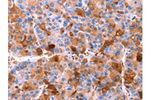 The image on the left is immunohistochemistry of paraffin-embedded Human liver cancer tissue using ABIN7190588(ERN2 Antibody) at dilution 1/40, on the right is treated with synthetic peptide. (ERN2 anticorps)