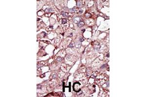 Formalin-fixed and paraffin-embedded human hepatocellular carcinoma tissue reacted with ACVRL1 polyclonal antibody  , which was peroxidase-conjugated to the secondary antibody, followed by DAB staining. (ACVRL1 anticorps  (N-Term))