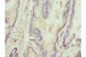 Immunohistochemistry of paraffin-embedded human prostate cancer using ABIN7168074 at dilution of 1:100 (Rhotekin anticorps  (AA 304-563))