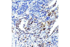Immunohistochemistry of paraffin-embedded human lung cancer using CD9 Rabbit mAb (ABIN7266227) at dilution of 1:100 (40x lens).