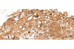 Immunohistochemistry of paraffin-embedded Human lung cancer tissue using KLHL36 Polyclonal Antibody at dilution of 1:55(x200) (KLHL36 anticorps)