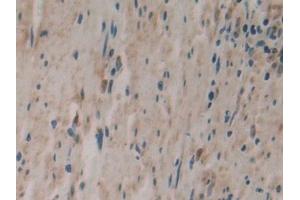 Detection of PLA2G4 in Human Colorectal cancer Tissue using Polyclonal Antibody to Cytosolic Phospholipase A2 (PLA2G4)