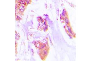 Immunohistochemical analysis of Cardiotrophin-1 staining in human lung cancer formalin fixed paraffin embedded tissue section.