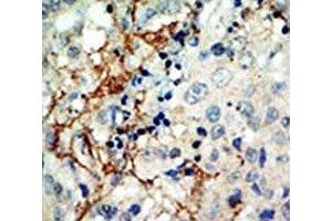 IHC analysis of FFPE human breast carcinoma tissue stained with the EphA3 antibody