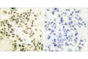 Peptide - +Immunohistochemical analysis of paraffin-embedded human breast carcinoma tissue using DNA-PK antibody.