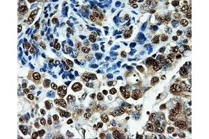 Immunohistochemical staining of paraffin-embedded Adenocarcinoma of breast tissue using anti-PKMYT1 mouse monoclonal antibody. (PKMYT1 anticorps)