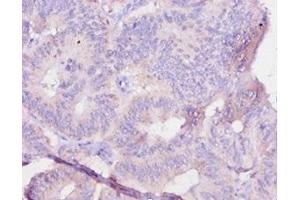 Immunohistochemistry of paraffin-embedded human colon cancer using ABIN7179323 at dilution of 1:10 (IL12B anticorps  (AA 23-327))