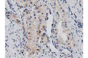 Immunohistochemical staining of paraffin-embedded Carcinoma of Human thyroid tissue using anti-PRKD2 mouse monoclonal antibody. (PKD2 anticorps)