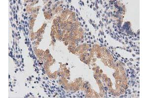 Immunohistochemical staining of paraffin-embedded Carcinoma of Human prostate tissue using anti-PTPRE mouse monoclonal antibody. (PTPRE anticorps)