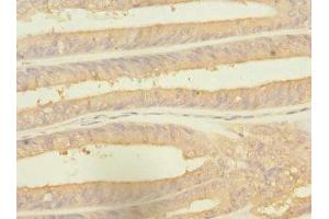 Immunohistochemistry of paraffin-embedded human endometrial cancer using ABIN7142540 at dilution of 1:100 (RPS27 anticorps  (AA 1-84))