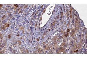 ABIN6276889 at 1/100 staining Human liver cancer tissue by IHC-P. (GABRA2 anticorps  (N-Term))