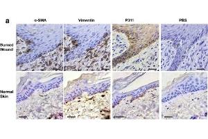 Expression patterns of vimentin, α-SMA, and P311 in the epidermis of human burn wounds.