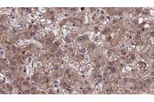 ABIN6273971 at 1/100 staining Human liver cancer tissue by IHC-P. (OR1J2/1N2 anticorps)