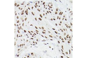 Immunohistochemistry of paraffin-embedded human esophageal cancer using CPSF6 Rabbit pAb (ABIN6128924, ABIN6138974, ABIN6138975 and ABIN6221646) at dilution of 1:100 (40x lens).