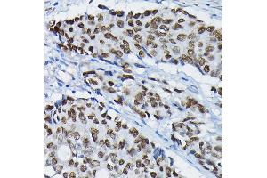 Immunohistochemistry of paraffin-embedded human colon carcinoma using S Rabbit pAb (ABIN7270154) at dilution of 1:100 (40x lens). (SATB2 anticorps  (AA 540-620))