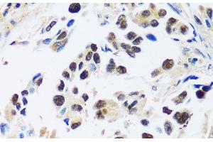 Immunohistochemistry of paraffin-embedded Human lung cancer using ASCL4 Polyclonal Antibody at dilution of 1:100 (40x lens). (ASCL4 anticorps)