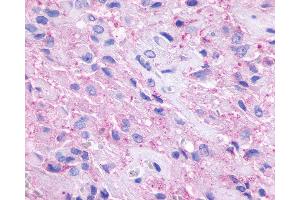 Anti-GPR148 antibody IHC of human Brain, Glioblastoma.