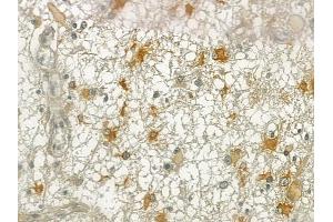 ABIN6257055 and ABIN6274988 at 1/100 staining human thyroid carcinoma by IHC-P. (CEP170 anticorps  (Internal Region))