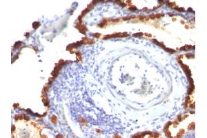 Formalin-fixed, paraffin-embedded human Lung Ca stained with Cytokeratin 7 Mouse Monoclonal Antibody (KRT7/760 + KRT7/903). (Cytokeratin 7 anticorps)