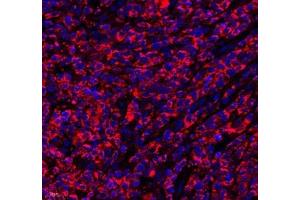 Immunofluorescence of paraffin embedded human lymphoma using septin1 (ABIN7074453) at dilution of 1: 650 (400x lens)
