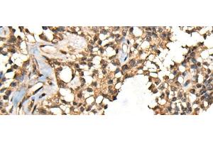 Immunohistochemistry of paraffin-embedded Human ovarian cancer tissue using CASK Polyclonal Antibody at dilution of 1:65(x200)