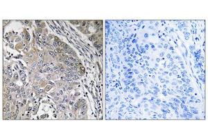 Immunohistochemistry analysis of paraffin-embedded human lung carcinoma tissue using SPINK6 antibody. (SPINK6 anticorps  (Internal Region))