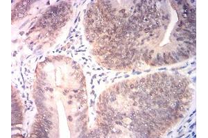 Immunohistochemical analysis of paraffin-embedded rectum cancer tissues using BRIP1 mouse mAb with DAB staining. (BRIP1 anticorps  (AA 904-986))